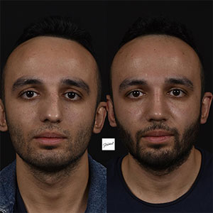 before-after